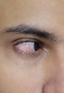 Dry Eye