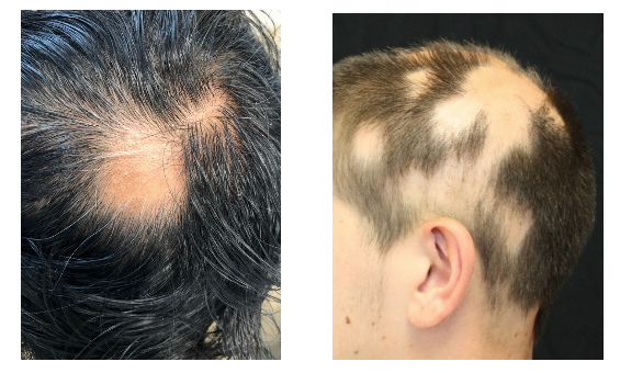 Alopecia Areata