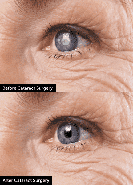 Cataract