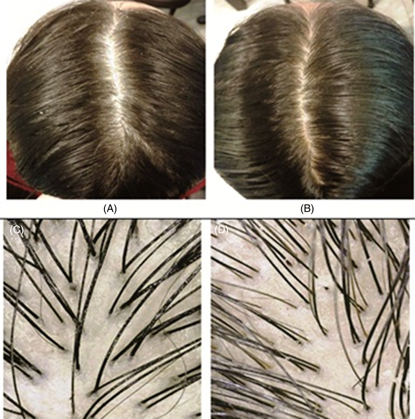 Telogen Effluvium