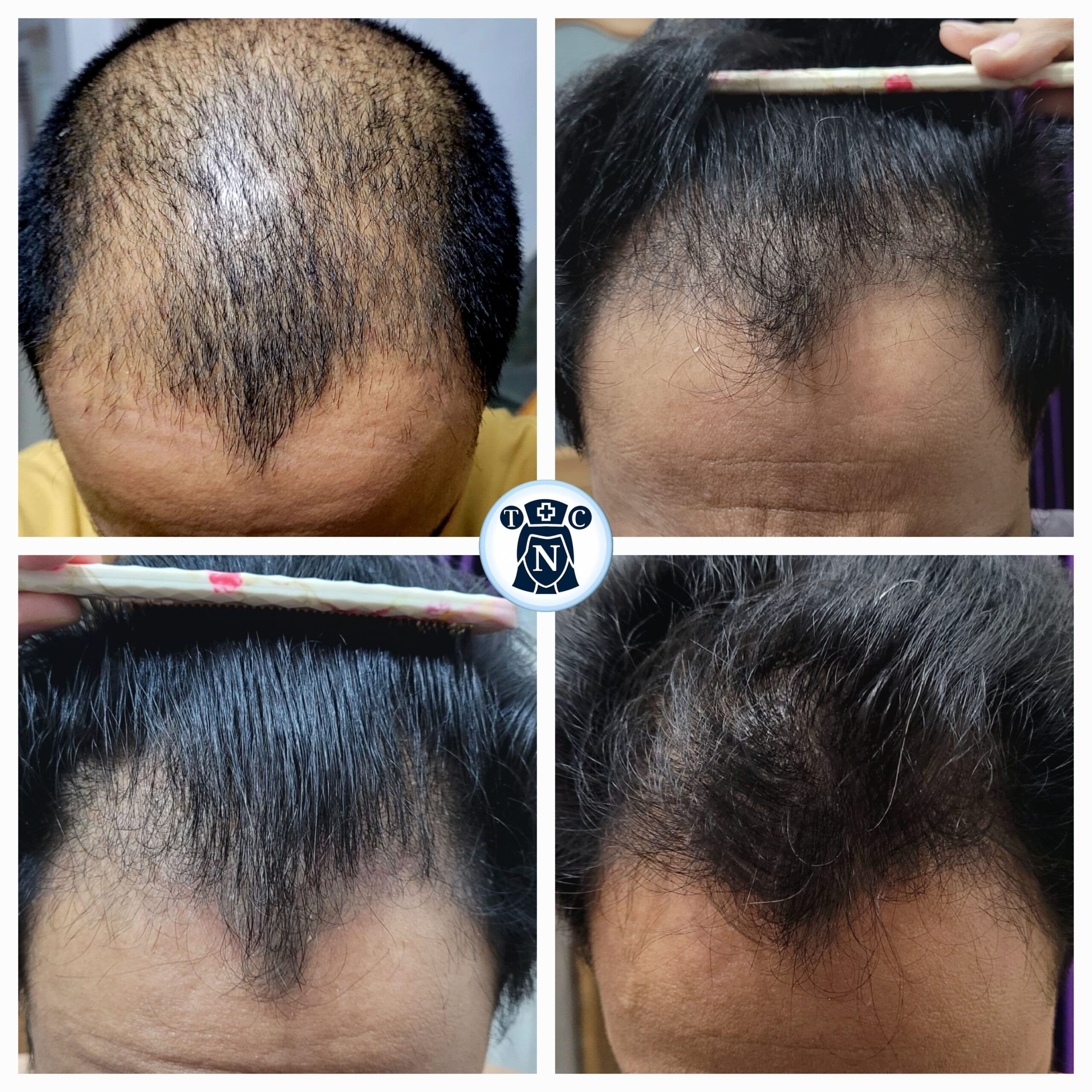 Real cause of hair loss 