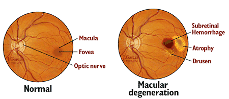 Macular Degeneration